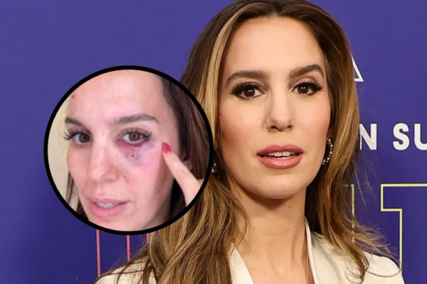 Dramático incidente en fiesta de cumpleaños: Ex actriz de Disney estuvo a punto de perder su ojo tras un disparo.